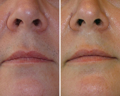 Lumea Skin Cyperus Rotundus Serum