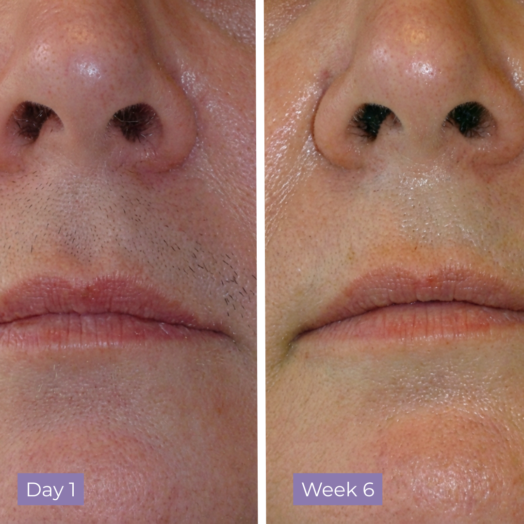 Lumea Skin Cyperus Rotundus Serum